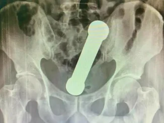 Radiografia-de-hombre-con-mancuerna