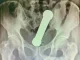 Radiografia-de-hombre-con-mancuerna