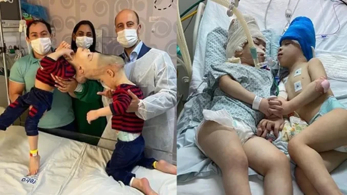 Separaron a siameses unidos por la cabeza en compleja cirugía