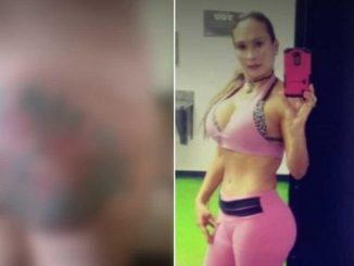 La mujer ahora se enfrenta a perder sus glúteos, aunque los profesionales luchan por salvarlos