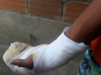 niños quemados con pólvora