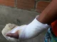 niños quemados con pólvora