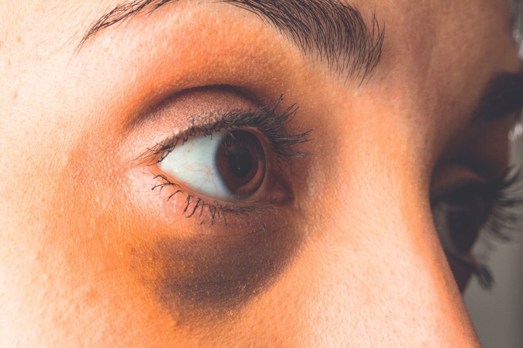 Ojeras ojos