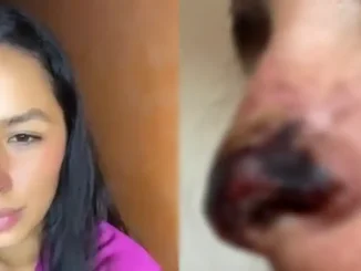 Se-puso-acido-hialuronico-en-la-nariz-y-casi-la-pierde-678x381