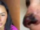 Se-puso-acido-hialuronico-en-la-nariz-y-casi-la-pierde-678x381