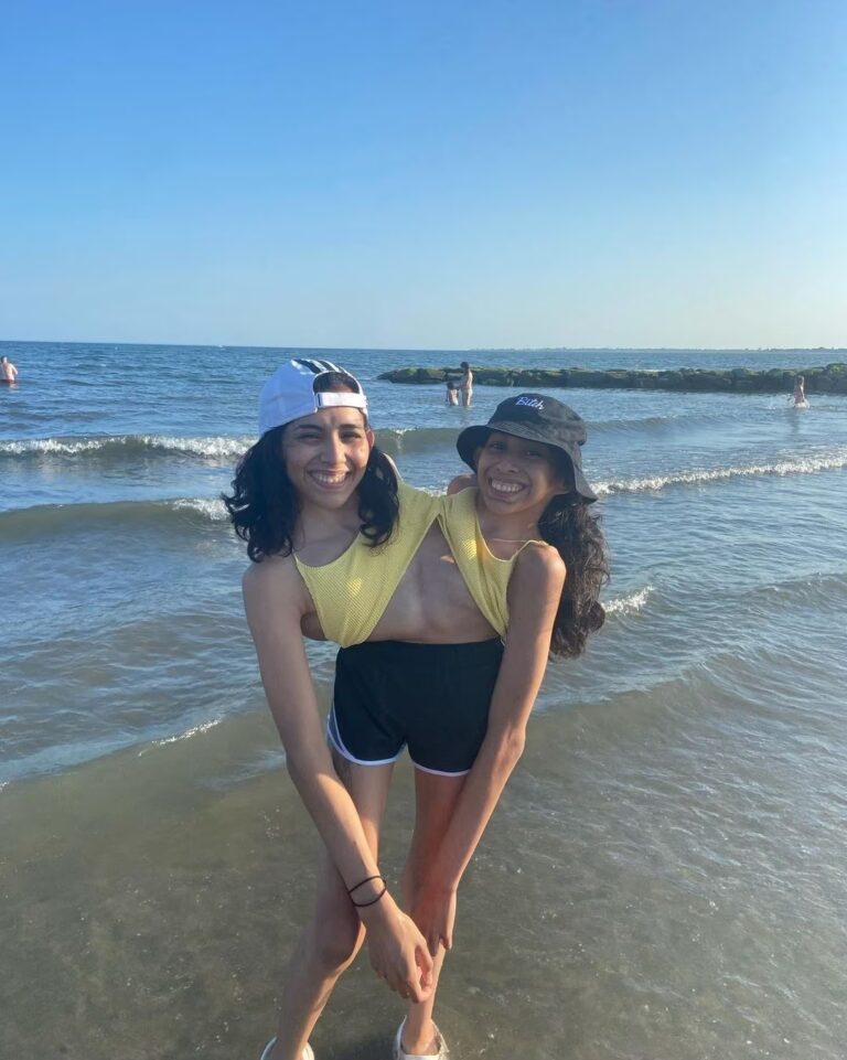 Hermanas siamesas