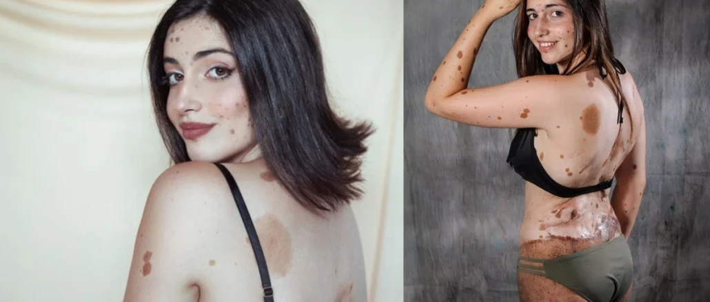 Lunares, Alba Parejo, española, viral, redes sociales, reinado, belleza, mujer real, lunares, mundo, internacional, noticias virales, Q’Hubo Medellín, Q’Hubo de hoy